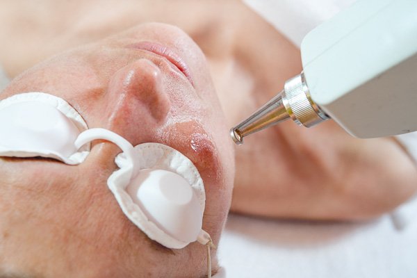 Laser treatment on a face with protective eye shields
