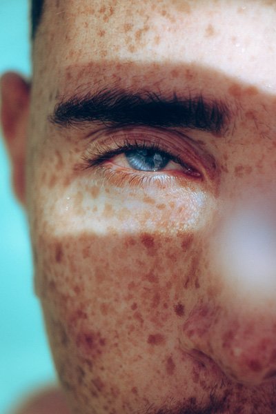Close-up of a face with pronounced pigment spots